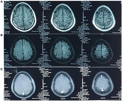 A Mistaken Diagnosis of Secondary Glioblastoma as Parasitosis